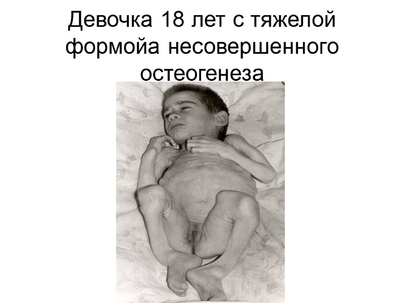 Девочка 18 лет с тяжелой формойа несовершенного остеогенеза